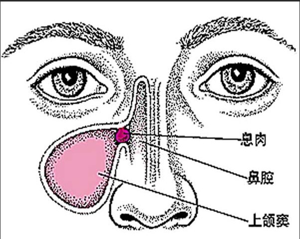 鼻息肉的预防方法