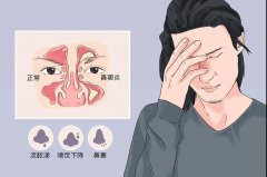 鼻窦炎的危害有哪些，重庆看鼻窦