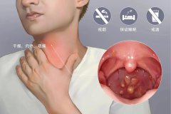 重庆看喉咙好的医院，慢性咽炎的有效治疗方法