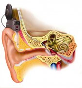 一篇搞懂人工耳蜗那些事